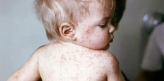 Disneyland Measles Outbreak