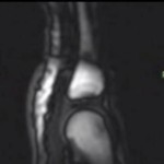 MRI Video of knuckles Cracking