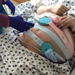 Rare Identical Triplets Two conjoined