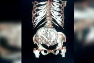 Chilean-woman-92-found-to-have-decades-old-fetus-in-abdomen