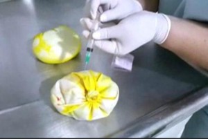 The breast implants removed from Paola Deyanira Sabillon were found to contain 3.3 pounds of liquid cocaine. ITN video screenshot