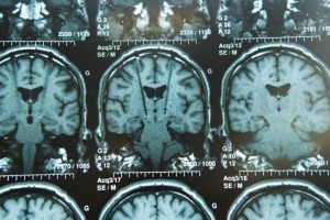 Deep-brain-stimulation-fails-to-improve-depression-symptoms-in-trial