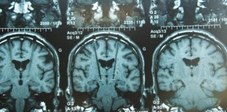Deep Brain Stimulation Fails to Improve Depression Symptoms