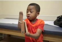 Zion Harvey before First Bilateral Hand Transplant