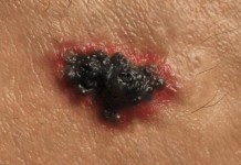FDA Approves Once-a-day Pill for Common Skin Cancer