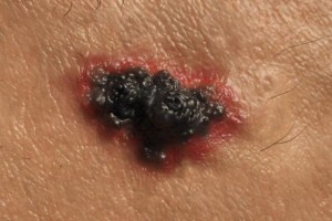 FDA-approves-once-a-day-pill-for-common-skin-cancer