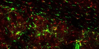 Stem Cell Treatment May Reduce Impairment Caused By Dementia