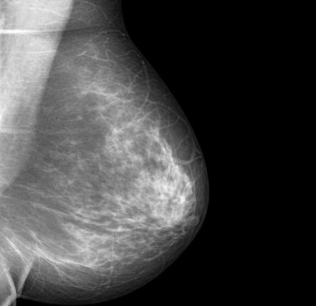 Breast-cancer-rates-rising-for-African-American-women