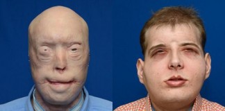 Most Extensive Face Transplant