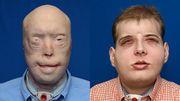 Most Extensive Face Transplant