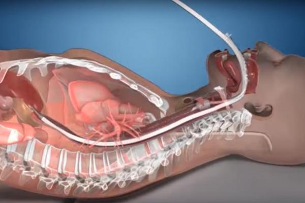 Esophageal Cooling Device