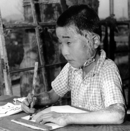 A schoolboy in Hiroshima in 1946 bears a large scar inflicted by the atomic bomb dropped on his city on Aug. 6, 1945. UPI File Photo